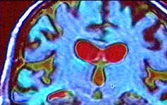 Brain scan