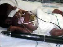 Amillia Taylor, the world's smallest surviving baby 