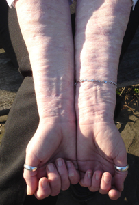 Mandy's scars